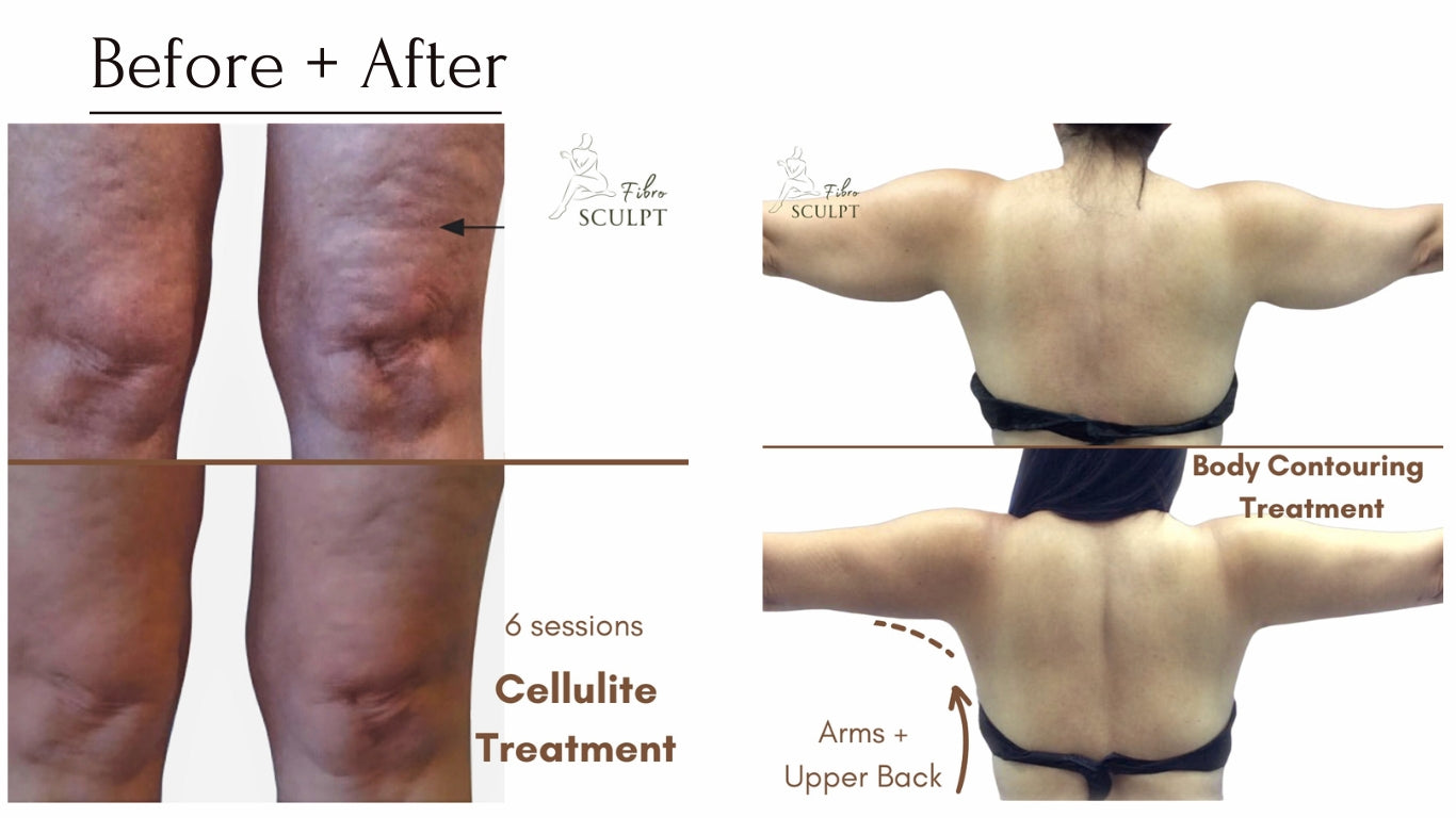 before-after-cellulite-body-contouring-skin-tightening-fibrosculpt