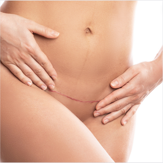 C-Section Scar Treatment