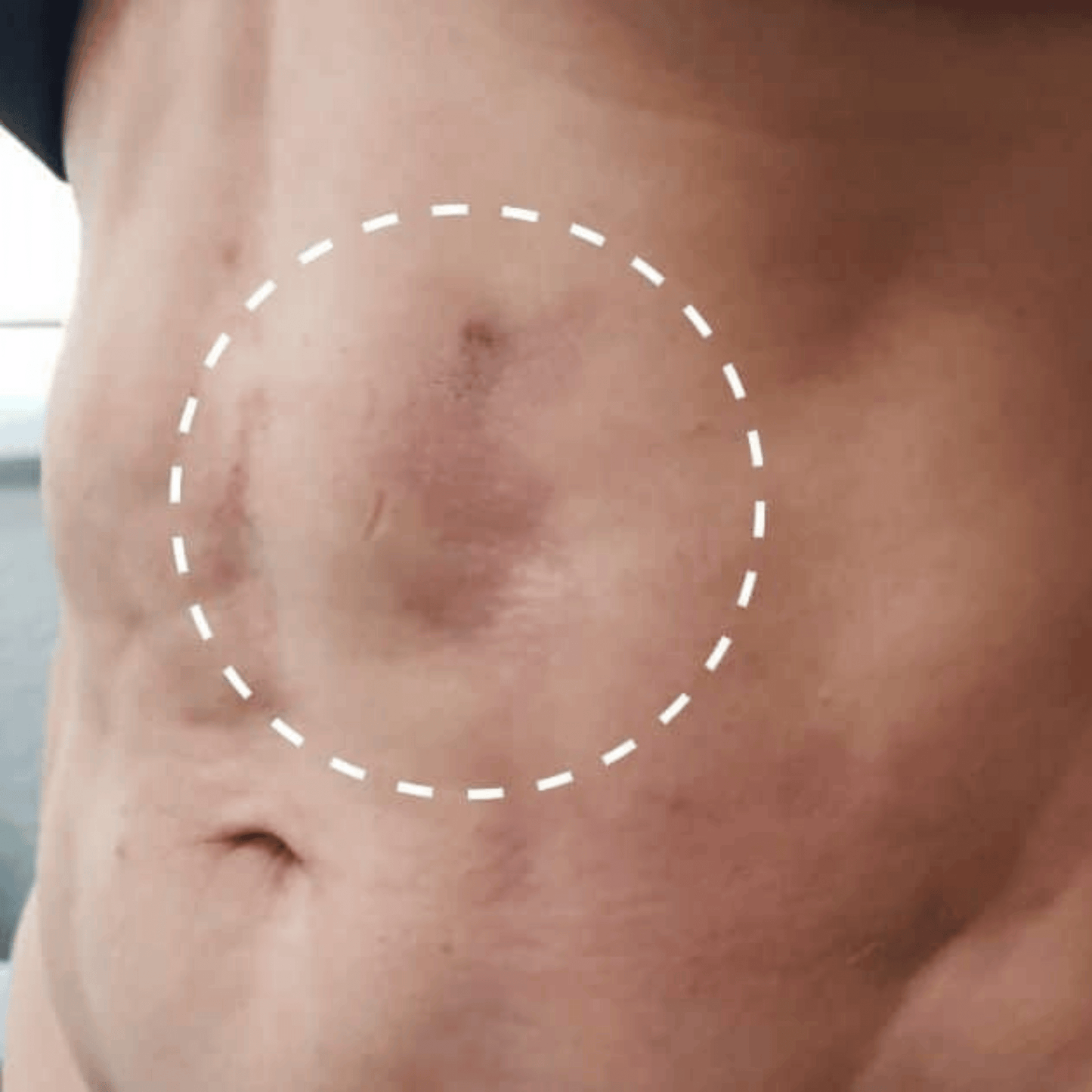 Fibrosis Treatment
