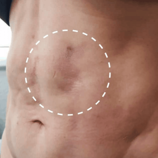 Fibrosis Treatment